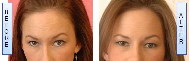 Botox injections for forehead lines and Glabellar wrinkles can last for 4 to 6 months